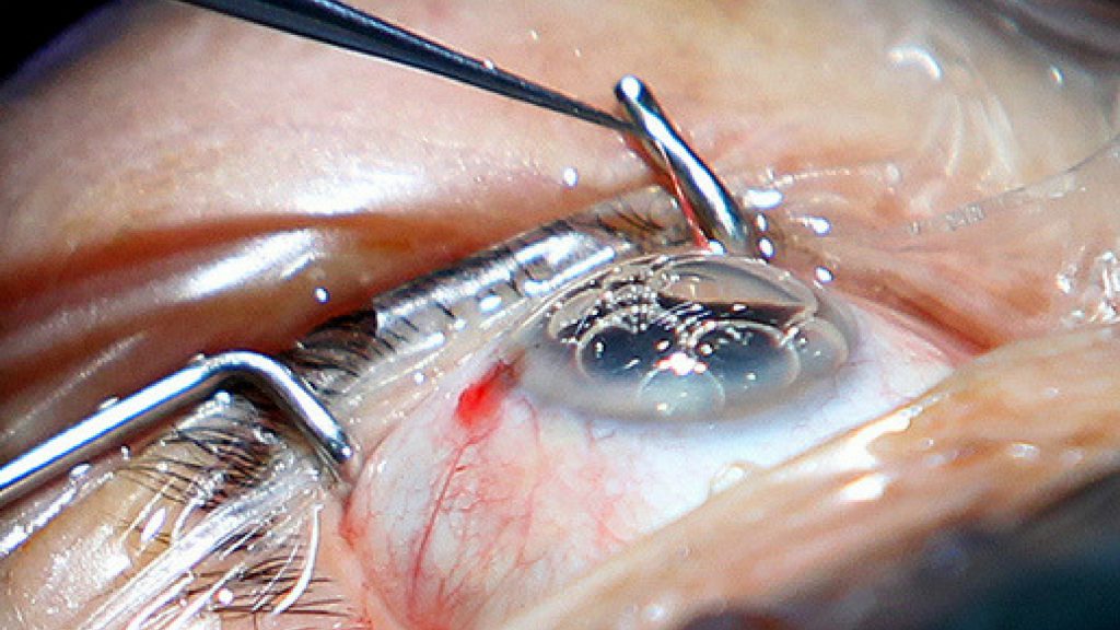 Cirugía de cataratas. Se muestra el ojo abierto con las pinzas que sujetan a los párpados preparándose para la operación con leve lavado para insertar los instrumentos quirúrgicos.