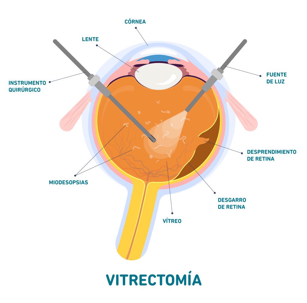 vitrectomía cirugía de retina en salauno
